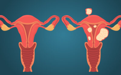 ¿Qué son los miomas uterinos? Te contamos lo que debes saber